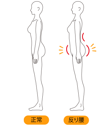 反り腰とは？
